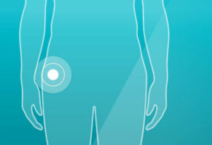 Diagram pinpoints the location of pain for a sports hernia which can be a factor in determining if it can heal on its own