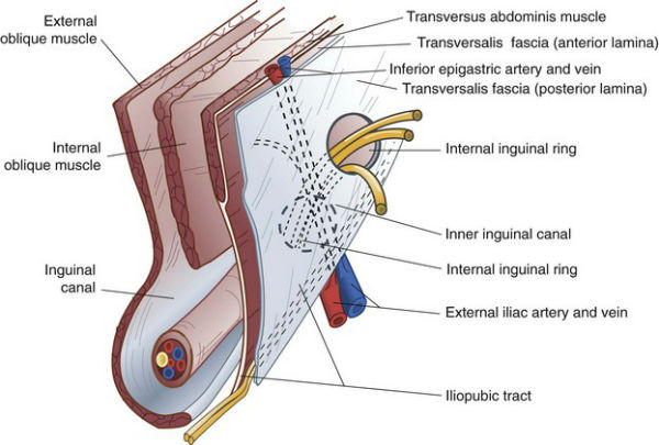 diagram highlighting weaknesses in the posterior inguinal wall leading to sports hernia testicular pain