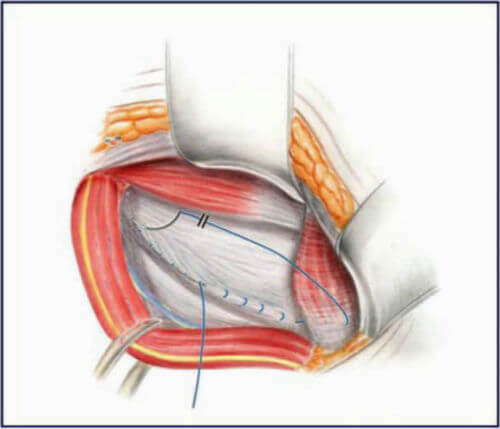 Sports Hernia Surgery Using the Minimal Repair Technique