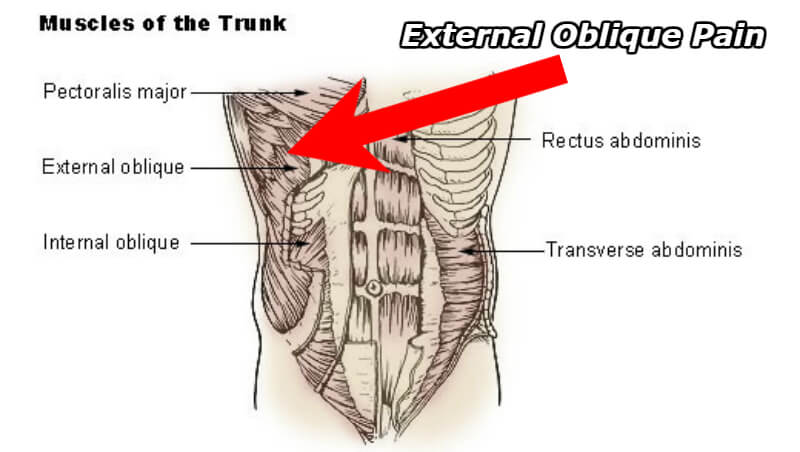 diagram displaying where external oblique pain is most common and outlines the different areas of a strain vs hernia