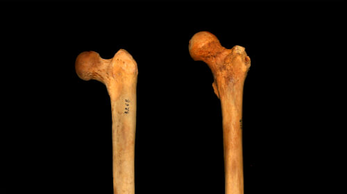 picture of two femurs; the person with the femur on the left will be able to squat much more narrow and this will require different powerlifting techniques than the person with the bone on the right