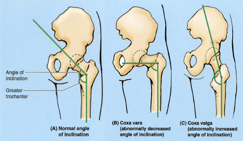 Diagram illustrating various hip angles which all require different stances and positioning when squatting, deadlifting, and even benching