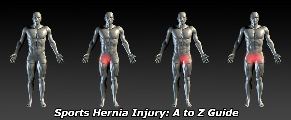 Inguinal Disruption (aka Sports Hernia) - Zamst Blog