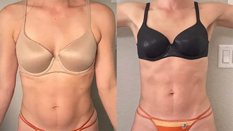 Lindsey is pictured on the left in a before photo wearing a tan top and orange bottoms with her arms at her sides, her lower stomach has a very small pouch to it and there is a small bulge from her hips coming out from her bottoms, but on the right in her after picture, Lindsey is in a black top but the same bottoms where her stomach is now totally flat and more defined with more muscular legs. 