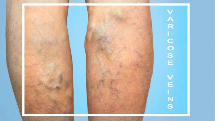 Purple, blue and green varicose veins on a person's legs.