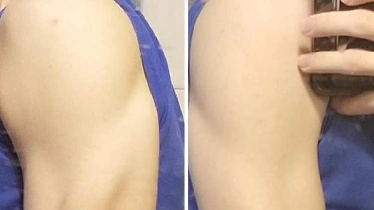 On the left is a guys left tricep that shows his lateral head is very developed but on the right the same guy flexes his right arm and none of the tricep heads are very visible. 