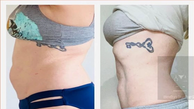 A before-and-after comparison of amber's body, with the left picture displaying her wearing a gray bra and blue underwear with belly fat and the right picture showing her wearing gray underwear depicting a change in her body shape and a visible tattoo, after using sermorelin for body transformation
