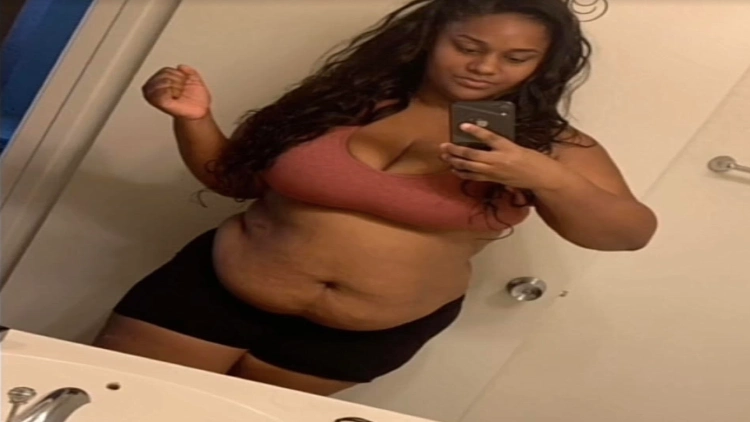 Cali prior to undergoing a tummy tuck procedure, in the image, Cali's stomach appears to protrude and there is loose skin visible in the area.