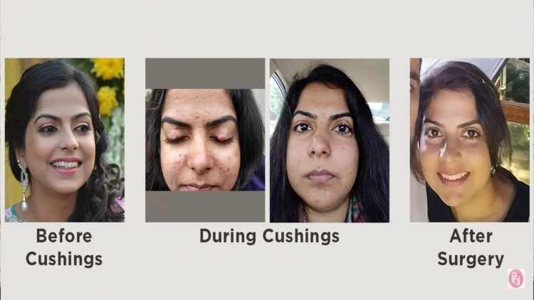 A four-panel photo series showing a woman's transformation before, during, and after Cushing's Syndrome and surgery where the first before picture depicts the woman in a healthy body shape and facial features while in the second and third panel, the woman appears significantly different, with a round face and prominent cheeks so she begins wondering "do I have Cushing's or am I just fat", then the fourth panel shows the woman with a healthy appearance and weight after surgery.