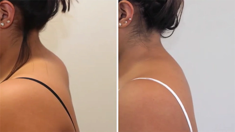 A side-by-side before and after photo set of a woman's buffalo hump and her back after getting rid of it where on the left she is wearing a black top that shows a buffalo hump behind her neck which made her wonder "if I lose weight will my buffalo hump go away", and on the right, she is wearing a top with white straps that reveal she lost weight and her buffalo hump disappeared.