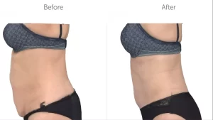 A before-and-after comparison of a woman's body where both images have her wearing a grey bra and black underwear although the left image shows her at a higher body fat percentage and pudge and the image on the right shows the same woman but with a flatter tummy and less excess skin since she achieved her goal to lose weight after a tummy tuck.