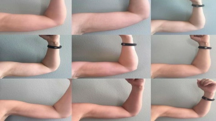 A nine same arm picture with visible weight loss, a reduction in fat, and increased muscle definition.