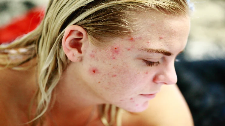 Close-up of a white woman's face with visible acne blemishes on her skin.