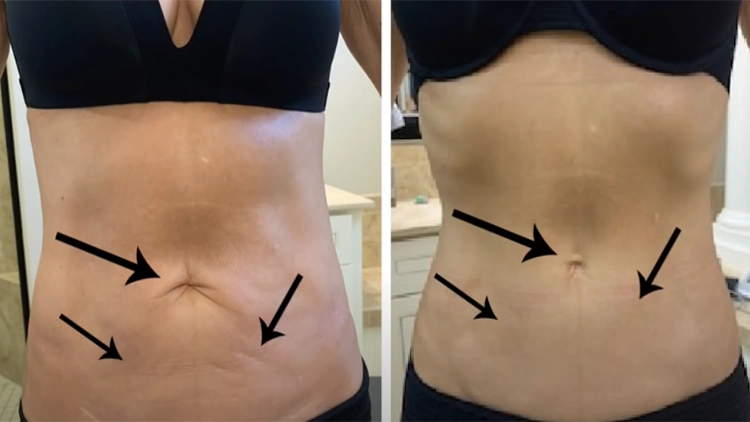 A side-by-side comparison of Beth's tummy skin after a surgery, on the left, her tummy skin is a bit loose as pointed by black arrows, and on the right, Beth recovered and tightened her tummy skin after dermarolling for months.
