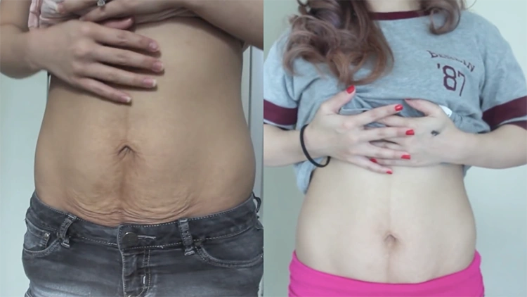 A side-by-side comparison of Lindy's loose skin across her stomach; on the left, Cindy is showing her stomach with noticeable loose skin, and on the right, Lindy showing her stomach after having skin tightening procedures.