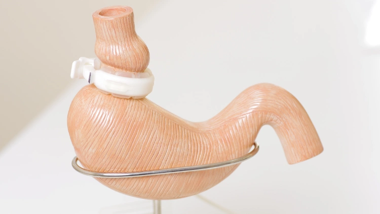 A replica of a human stomach is seen placed on a clear white background, the stomach replica has a lap-band wrapped around it, which is a medical device used to assist in weight loss, the clear white background allows for a clear and focused view of the stomach replica and the lap-band.