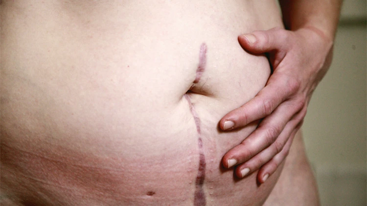 A topless overweight woman holding her belly while showing an incision scar.
